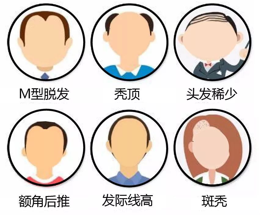 sci期刊bmj文献| 脱发人群冠心病发病风险更高